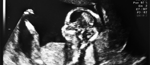 bebé en ultrasonido